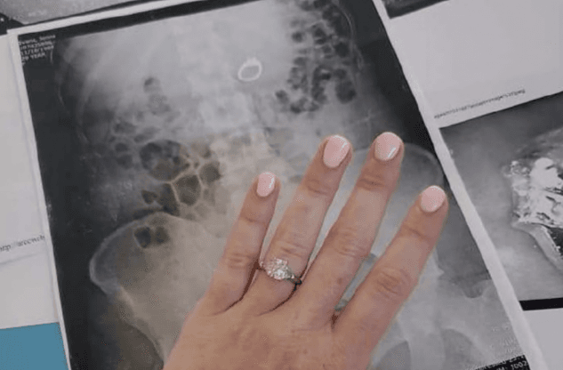 This Bride-To-Be Swallowed Her Engagement Ring During Her Nightmare